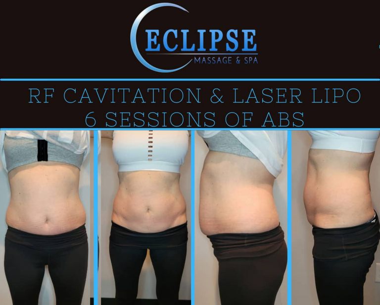 RF Face & Body Sculpting - Eclipse Massage and Spa - Where Health